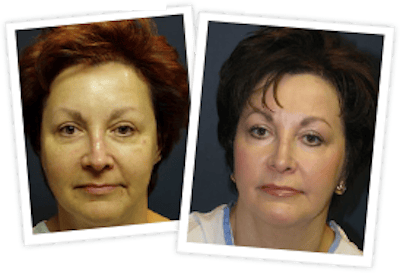 Chemical Peel / Skin Resurfacing Before & After Gallery - Patient 10380757 - Image 1