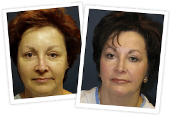 Chemical Peel / Skin Resurfacing Before & After Gallery - Patient 10380757 - Image 1