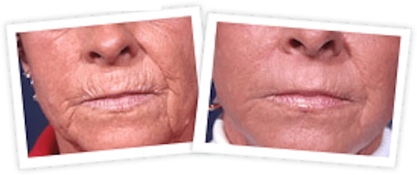 Chemical Peel / Skin Resurfacing Before & After Gallery - Patient 10380759 - Image 1