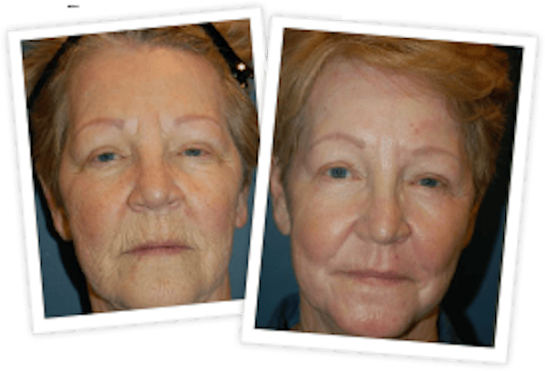 Chemical Peel / Skin Resurfacing Before & After Gallery - Patient 10380756 - Image 1
