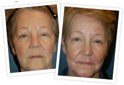 Skin Resurfacing