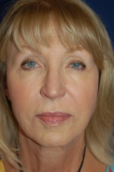 Fat Transfer Before & After Gallery - Patient 10380372 - Image 1