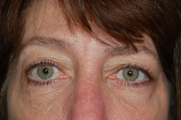 Eyelid Surgery