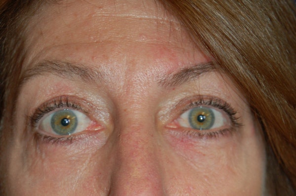 Eyelid Surgery