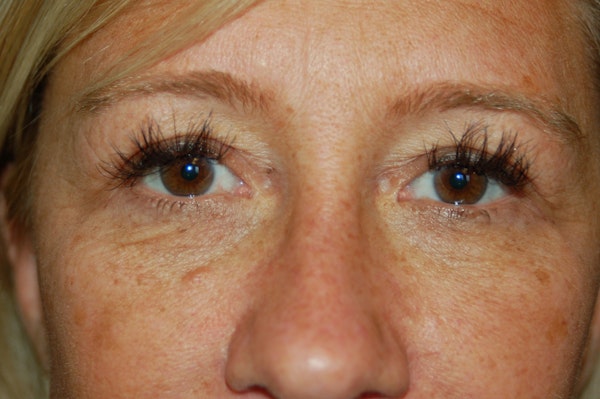 Eyelid Surgery