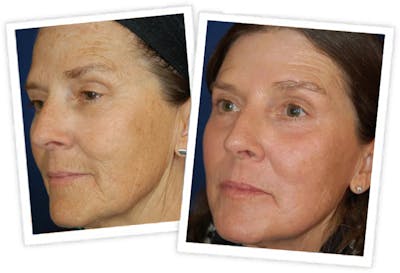 Chemical Peel / Skin Resurfacing Before & After Gallery - Patient 11264560 - Image 2