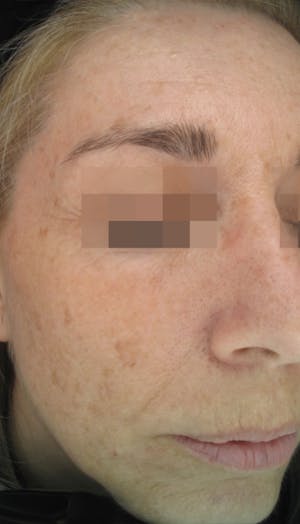 Cosmelan Peel