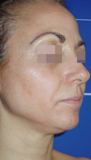 Cosmelan Peel