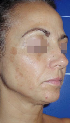 Cosmelan Peel