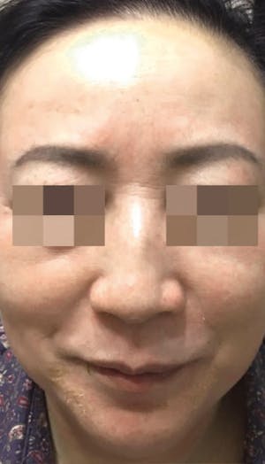 Cosmelan Peel