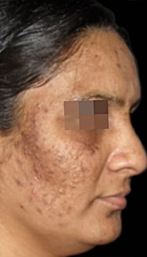 Cosmelan Peel