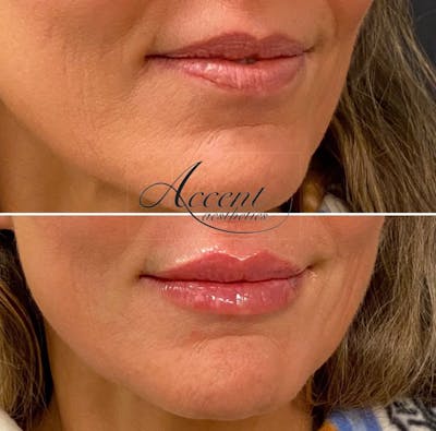 Lip Filler Before & After Gallery - Patient 180041 - Image 1