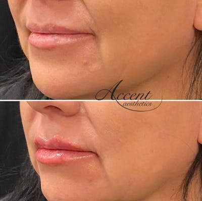 Lip Filler Before & After Gallery - Patient 159518 - Image 1