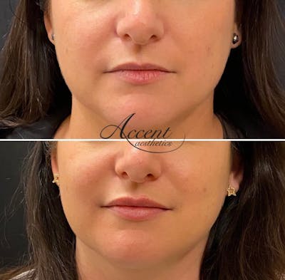 Lip Filler Before & After Gallery - Patient 249234 - Image 1