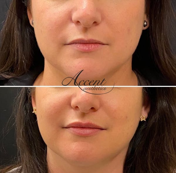 Lip Filler Before & After Gallery - Patient 249234 - Image 1