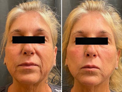 Dermal Filler Before & After Gallery - Patient 339376 - Image 1