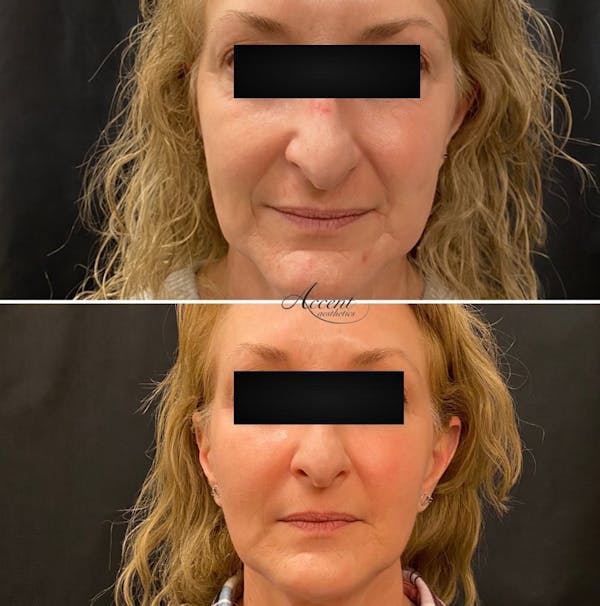 Dermal Filler Before & After Gallery - Patient 110689 - Image 1
