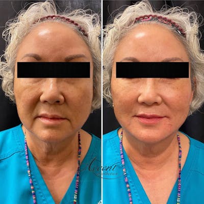 Dermal Filler Before & After Gallery - Patient 130876 - Image 1