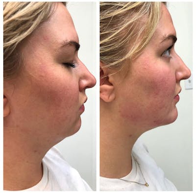 Dermal Filler Before & After Gallery - Patient 253877 - Image 1
