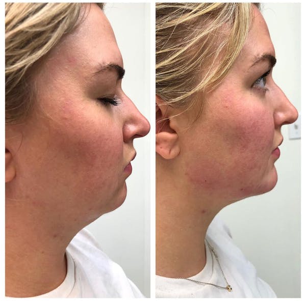 Dermal Filler Before & After Gallery - Patient 253877 - Image 1