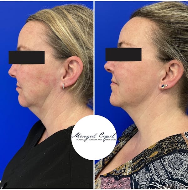 Dermal Filler Before & After Gallery - Patient 102497 - Image 1