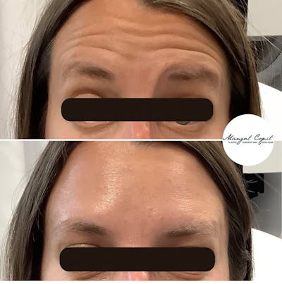  Neuromodulator Treatment Before & After Gallery - Patient 145448 - Image 1