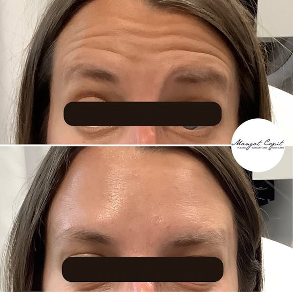  Neuromodulator Treatment Before & After Gallery - Patient 145448 - Image 1