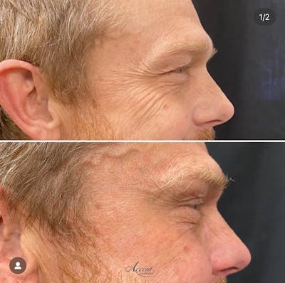  Neuromodulator Treatment Before & After Gallery - Patient 253456 - Image 1