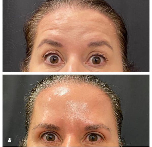 Neuromodulator Treatment Before & After Gallery - Patient 422142 - Image 1