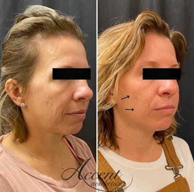 Sculptra Before & After Gallery - Patient 378979 - Image 1