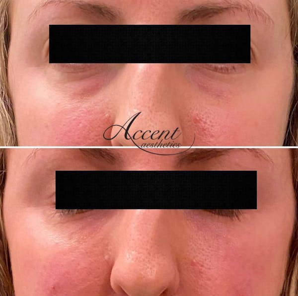 Under Eye Filler Before & After Gallery - Patient 223180 - Image 1