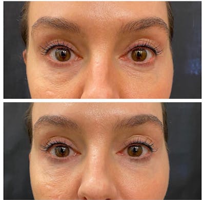 Under Eye Filler Before & After Gallery - Patient 219122 - Image 1