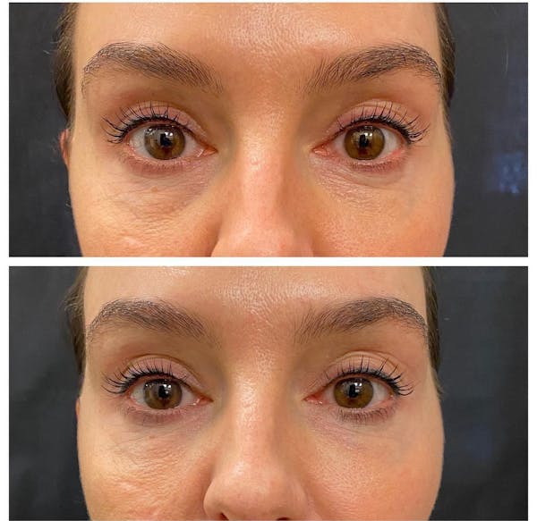 Under Eye Filler Before & After Gallery - Patient 219122 - Image 1