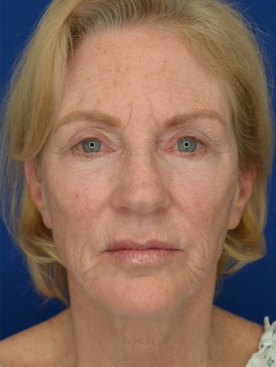 Facelift Before & After Gallery - Patient 160335 - Image 1