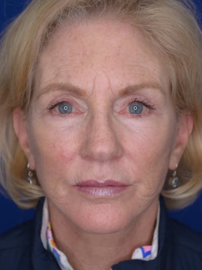 Facelift Before & After Gallery - Patient 160335 - Image 2