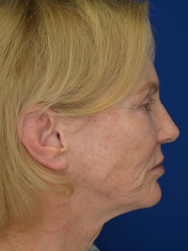 Facelift Before & After Gallery - Patient 160335 - Image 3