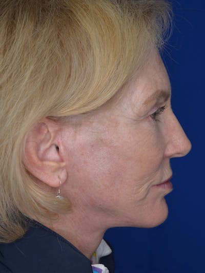 Facelift Before & After Gallery - Patient 160335 - Image 4