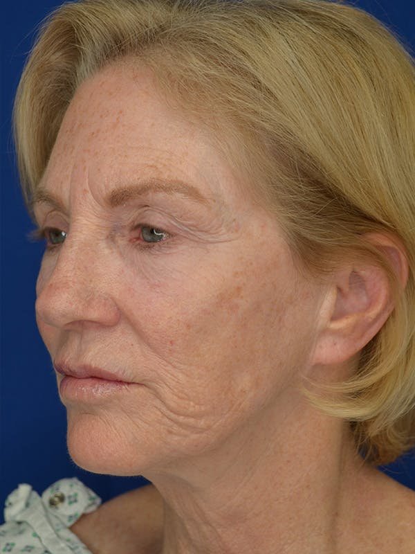 Facelift Before & After Gallery - Patient 160335 - Image 5