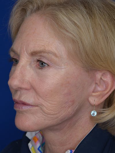 Facelift Before & After Gallery - Patient 160335 - Image 6