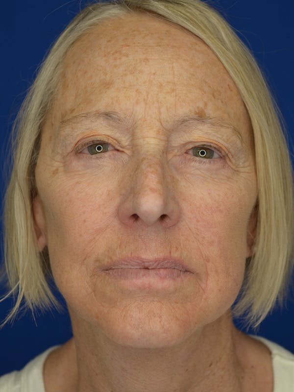 Facelift Before & After Gallery - Patient 172703 - Image 4