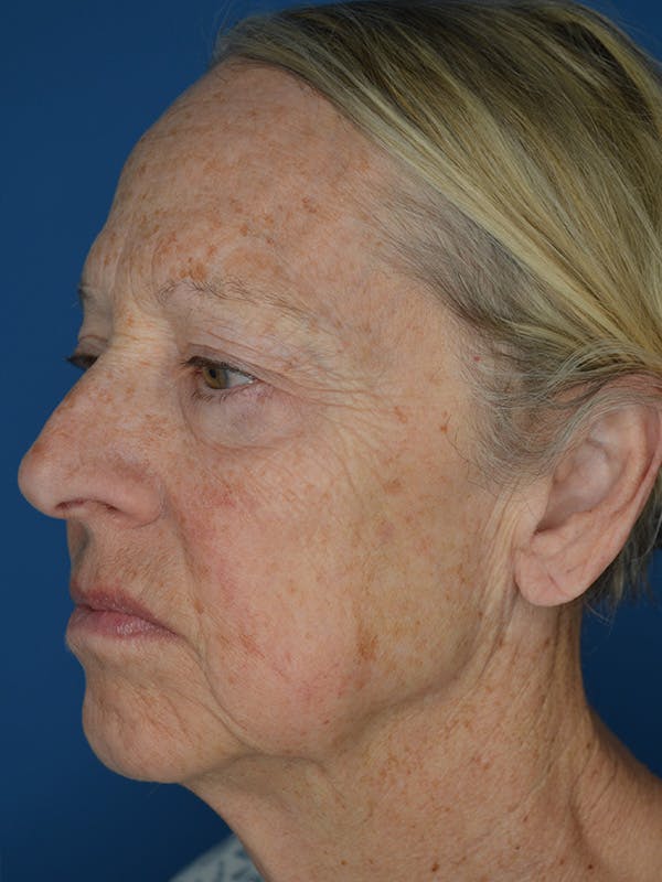 Facelift Before & After Gallery - Patient 172703 - Image 5