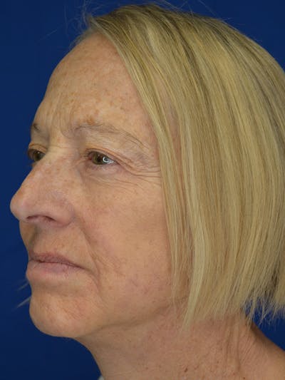 Facelift Before & After Gallery - Patient 172703 - Image 6