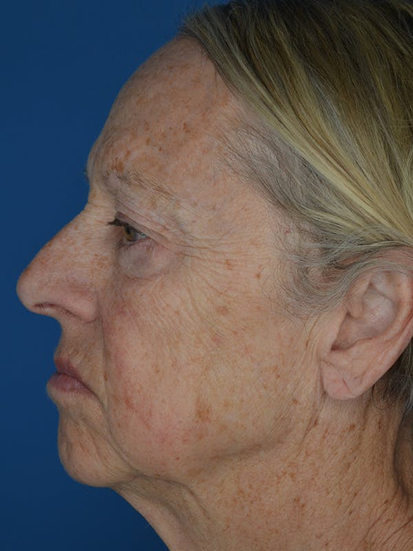 Facelift Before & After Gallery - Patient 172703 - Image 7
