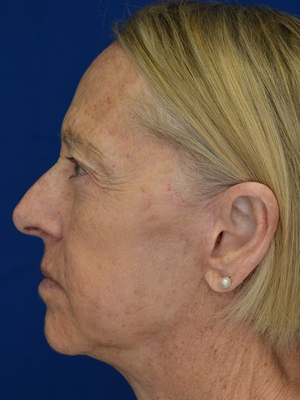 Facelift Before & After Gallery - Patient 172703 - Image 8