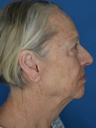 Facelift Before & After Gallery - Patient 172703 - Image 1