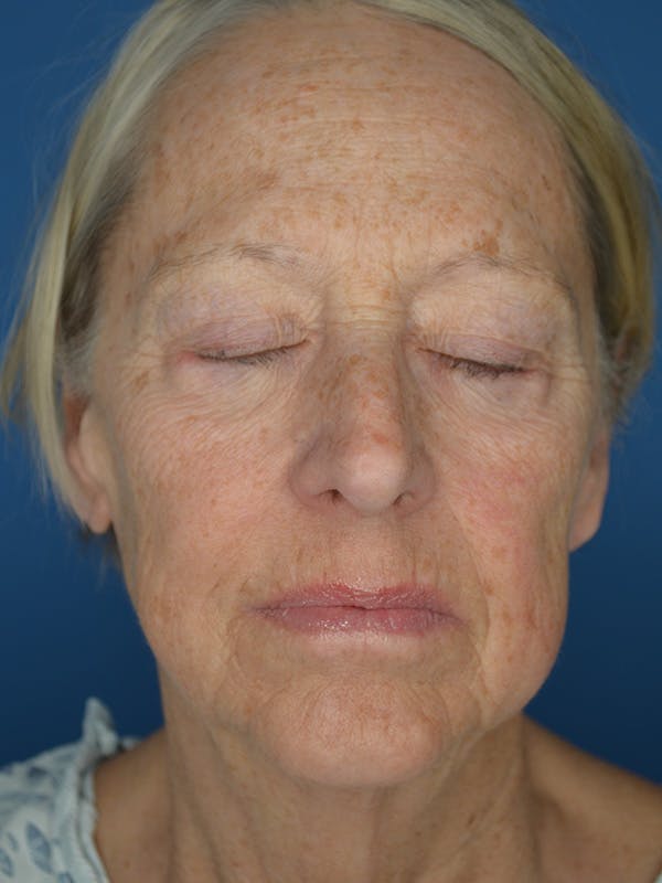 Facelift Before & After Gallery - Patient 172703 - Image 3