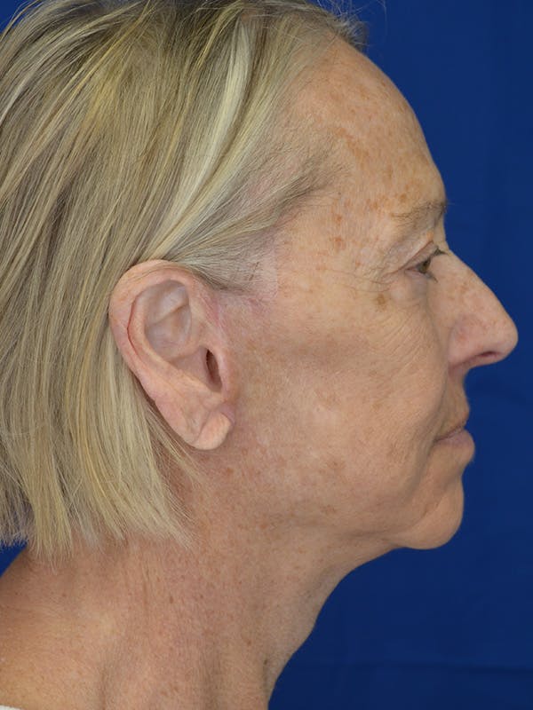 Facelift Before & After Gallery - Patient 172703 - Image 2