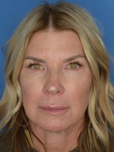 Facelift Before & After Gallery - Patient 115416 - Image 1