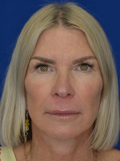 Facelift Before & After Gallery - Patient 115416 - Image 2