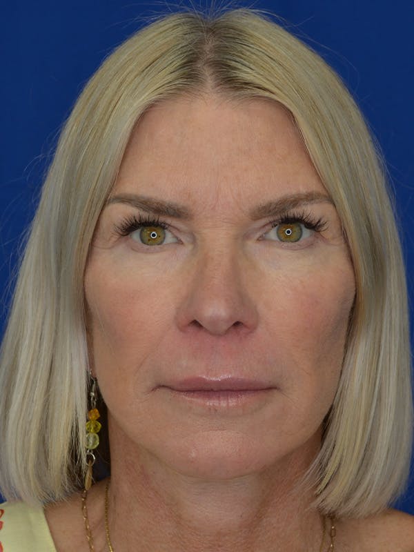 Facelift Before & After Gallery - Patient 115416 - Image 2